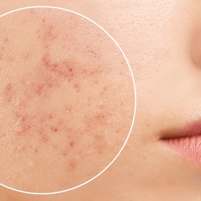 5 طرق لمنع ظهور البثور بعد إزاله شعر الوجه بالخیط