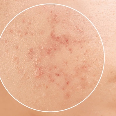 5 طرق لمنع ظهور البثور بعد إزاله شعر الوجه بالخیط