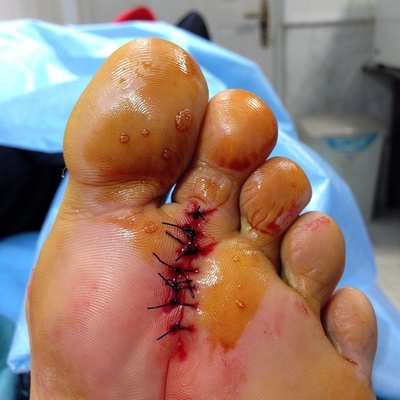 علاجات منزلیه للتخلص من مسامیر القدم دون جراحه