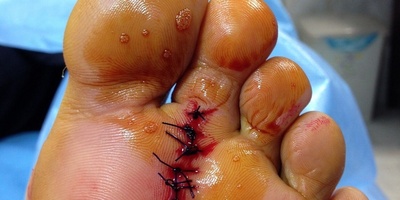 علاجات منزلیه للتخلص من مسامیر القدم دون جراحه