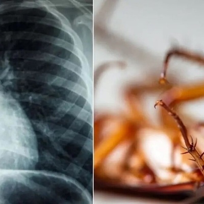 إزاله صرصور حی بطول 4 سنتیمترات من رئه رجل یبلغ من العمر 55 عامًا
