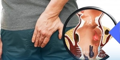ما هی البواسیر النازفه ولماذا تحدث؟