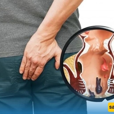 ما هی البواسیر النازفه ولماذا تحدث؟