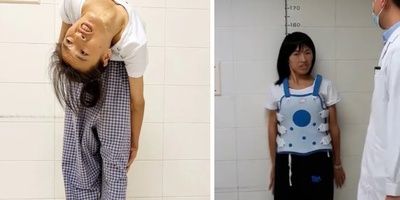 القضیه الغریبه لامرأه انحنى عمودها الفقری 180 درجه إلى الخلف، لیصل رأسها إلى خصرها [صوره]