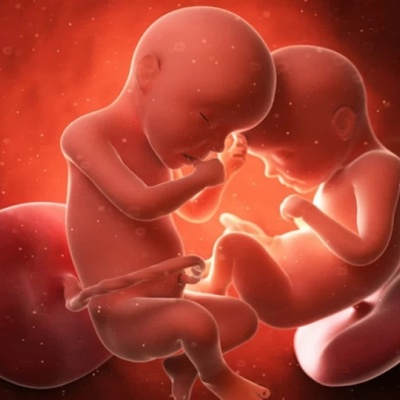 خروج جنین من رأس أخته التوأم داخل رحم الأم + صوره تصویر بالموجات فوق الصوتیه