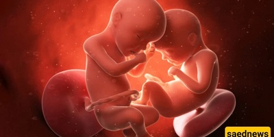 خروج جنین من رأس أخته التوأم داخل رحم الأم + صوره تصویر بالموجات فوق الصوتیه