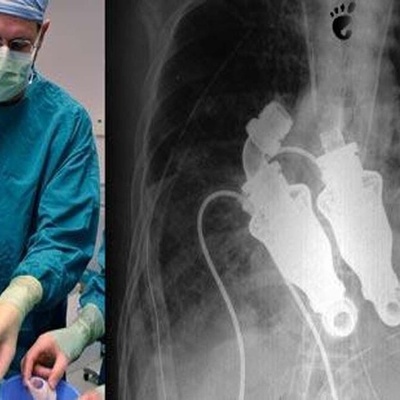 أوَحَدُ إنسان حی فی العالم بدون قلب