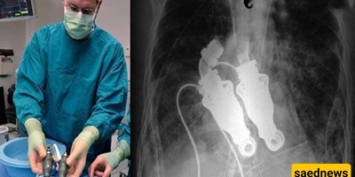 أوَحَدُ إنسان حی فی العالم بدون قلب