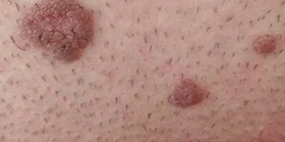 الثآلیل التناسلیه: حاله صامته ومعدیه یسببها فیروس الورم الحلیمی البشری (HPV)