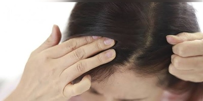 فهم أسباب تقشّر فروه الرأس وأعراضه وأفضل طرق علاجه