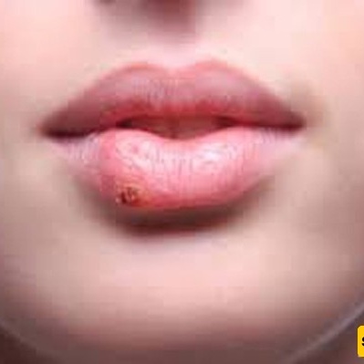 الصله العلمیه بین قروح البرد وبدایه مرض ألزهایمر