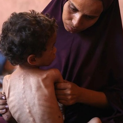 وزاره الصحه بغزه: ارتفاع عدد شهداء المجاعه وسوء التغذیه داخل القطاع إلى 222 شخصا