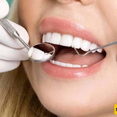 لماذا تتکسر حشوه الکمبوزیت السنی أو تتشقق؟ الأسباب وحلول الإصلاح