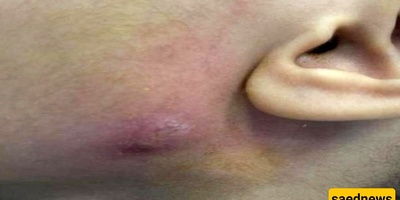 کیف تزیل دوده من وجه طفل یبلغ من العمر 8 سنوات (مع الصور)