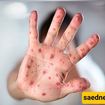 موجه الحصبه فی بنغلادیش تودی بحیاه 500 طفل
