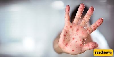 موجه الحصبه فی بنغلادیش تودی بحیاه 500 طفل