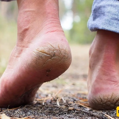 نقص هذه الفیتامینات الثلاثه قد یسبب تشقق الکعبین