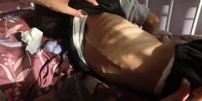 یونیسیف تحذر: سوء تغذیه الأطفال فی غزه یرتفع بشکل حاد وسط قیود إسرائیلیه على المساعدات