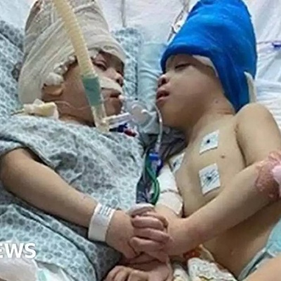 جراحه التوأم الملتصق بمساعده تقنیه الواقع الافتراضی!