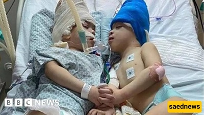 جراحه التوأم الملتصق بمساعده تقنیه الواقع الافتراضی!
